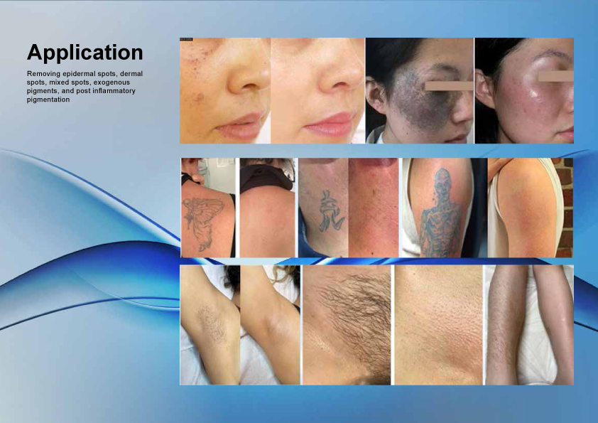 Weifang KM MDR Picosecond laser Q-switched nd yag laser pigment removal tattoo removal laser beauty equipment