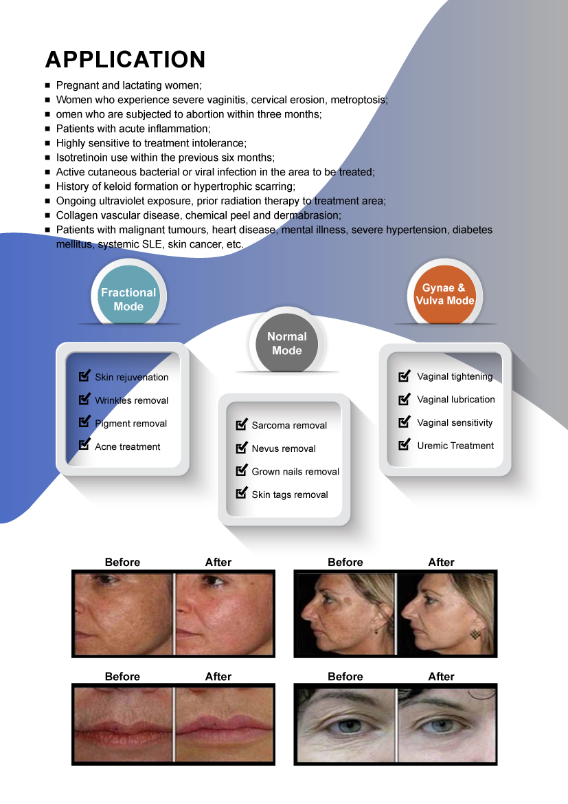 KM Vaginal Tightening Co2 Fractional Laser Machine Acne Scar Removal Skin Resurfacing CO2 Laser Scar Removal Whitening CO2 Laser KM Vaginal Tightening Co2 Fractional Laser Machine Acne Scar Removal Skin Resurfacing CO2 Laser Scar Removal Whitening CO2 Laser